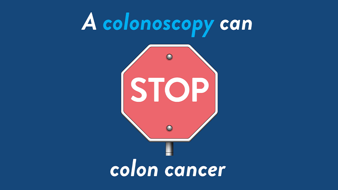 A colonoscopy can stop colon cancer